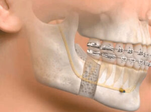 Read more about the article Çene Cerrahisi Nedir?