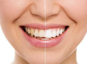 Read more about the article Diş Beyazlatma Nedir?