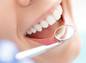 Read more about the article Diş Beyazlatmanın Yan Etkileri