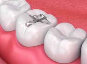 Diş Dolgusunun Faydaları