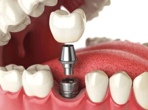 Diş İmplantı Nasıl Yapılır?