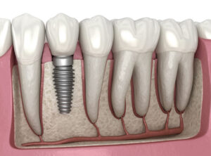 Diş İmplantı Nedir?