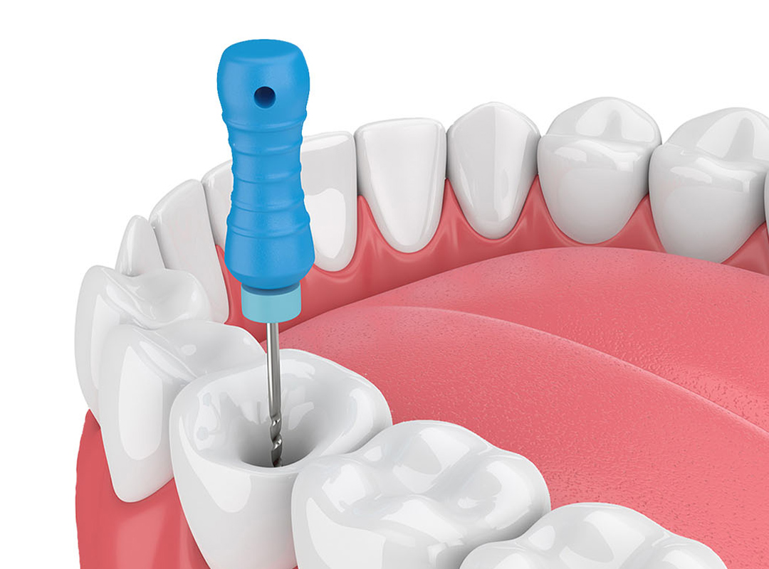 Read more about the article Kanal Tedavisi Örnekleri