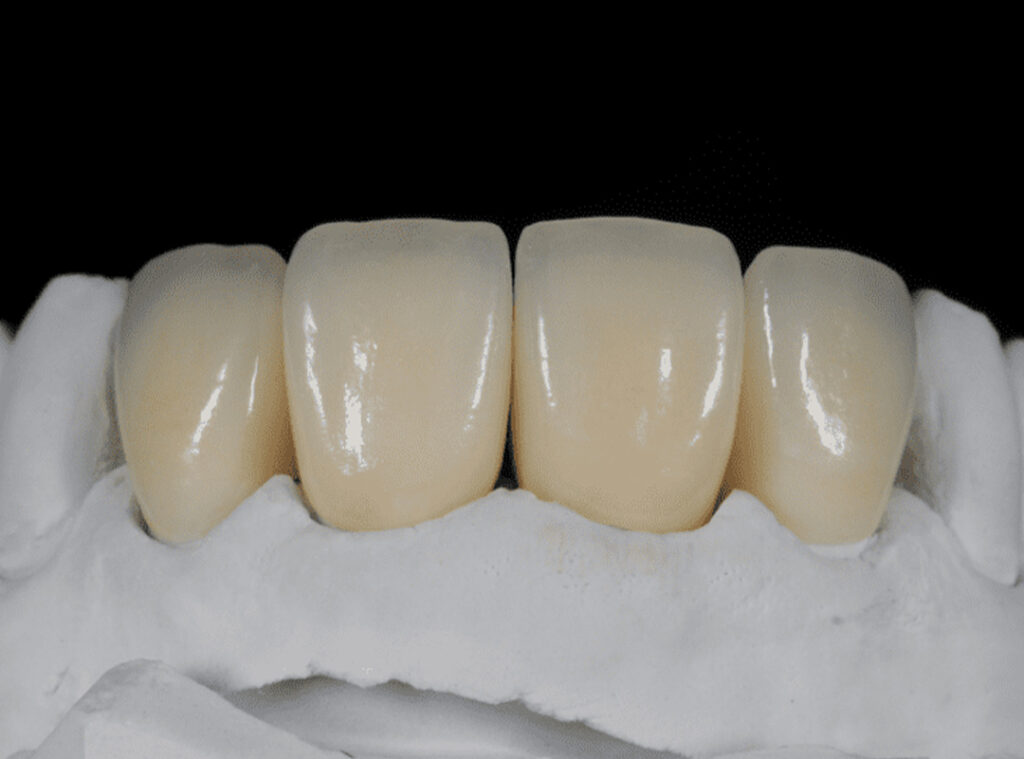 Zirkonyum Yaptırılır mı?