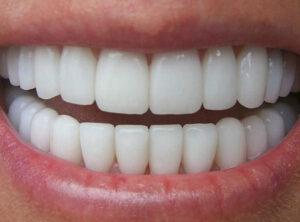 Read more about the article Zirkonyum Nedir?