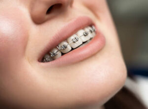 Read more about the article Ortodontinin Yan Etkileri