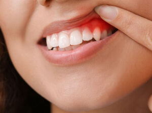 Read more about the article Diş Eti Hastalıkları Ve Tedavi Yöntemleri