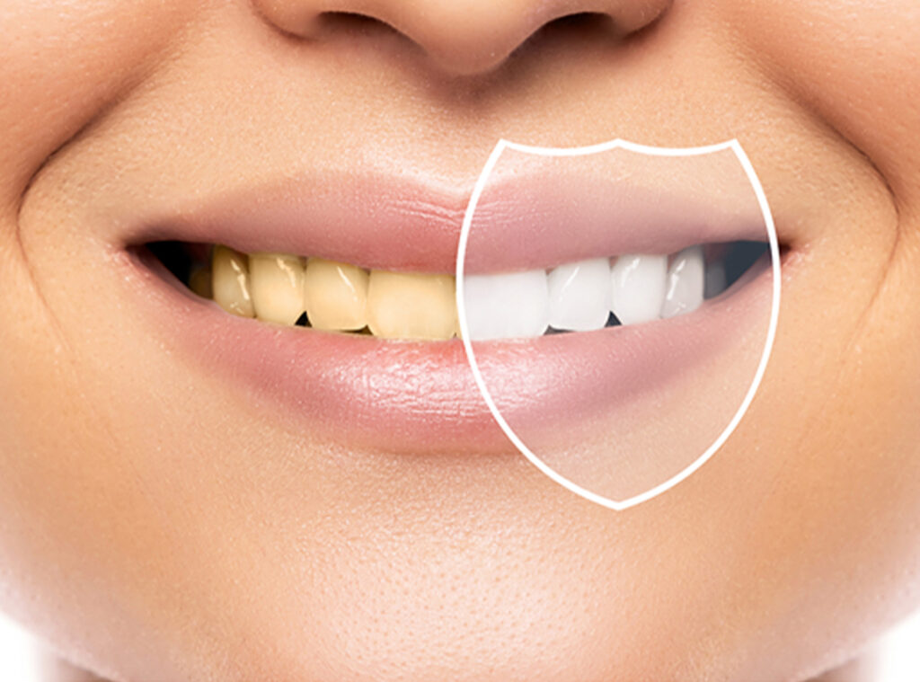 Diş Beyazlatma Fiyatları
