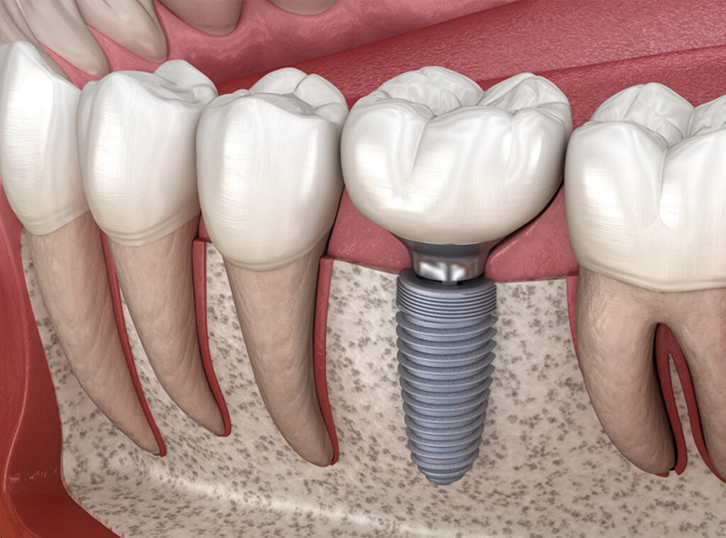 Diş İmplant Fiyatları