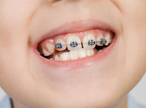 Read more about the article Çocuklarda Tel Tedavisi