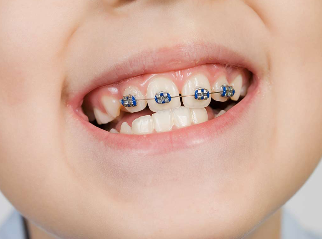 Çocuklarda Tel Tedavisi