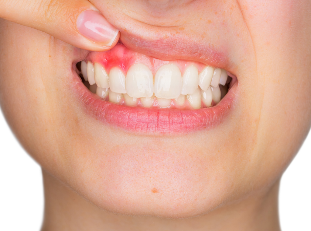 Diş Eti Hastalığı: Belirtileri, Çeşitleri ve Tedavi Yöntemleri